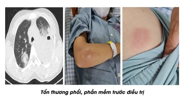 Cứu sống phụ nữ bị vi khuẩn Whitmore tấn công